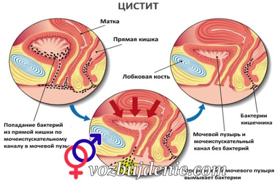 цистит у женщин 