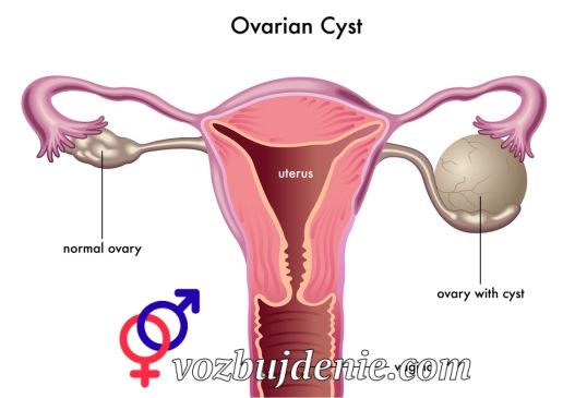 киста яичника