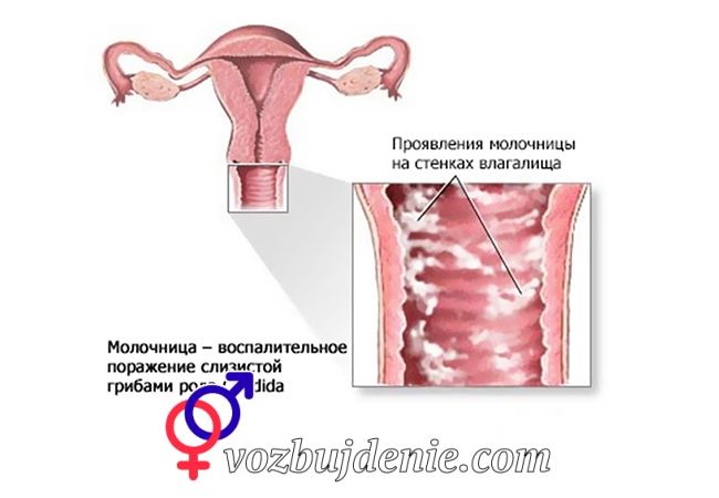 Молочница и как она проявляется