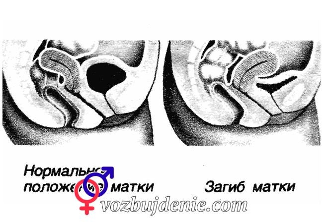 Загиб матки у здоровой женщины